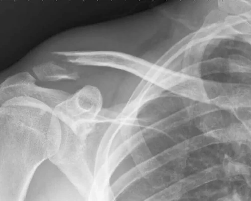 Chest X-Ray Imaging Procedure at Arihant Imaging Centre