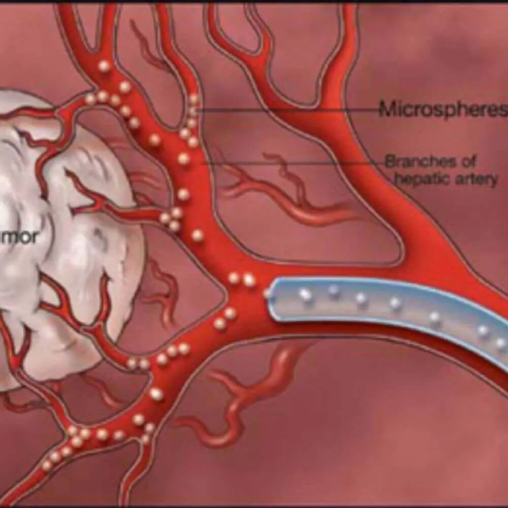 Gastrointestinal interventional radiology procedure