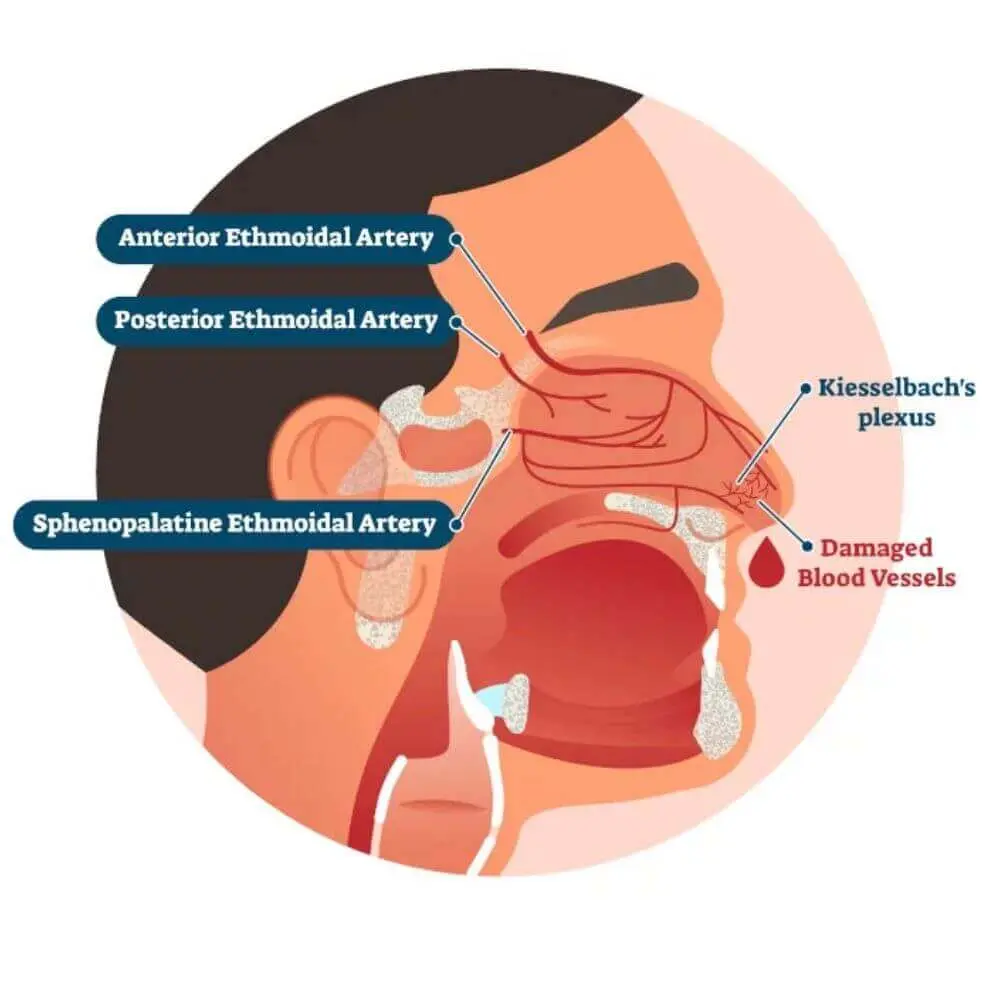 Head and neck interventional radiology procedure