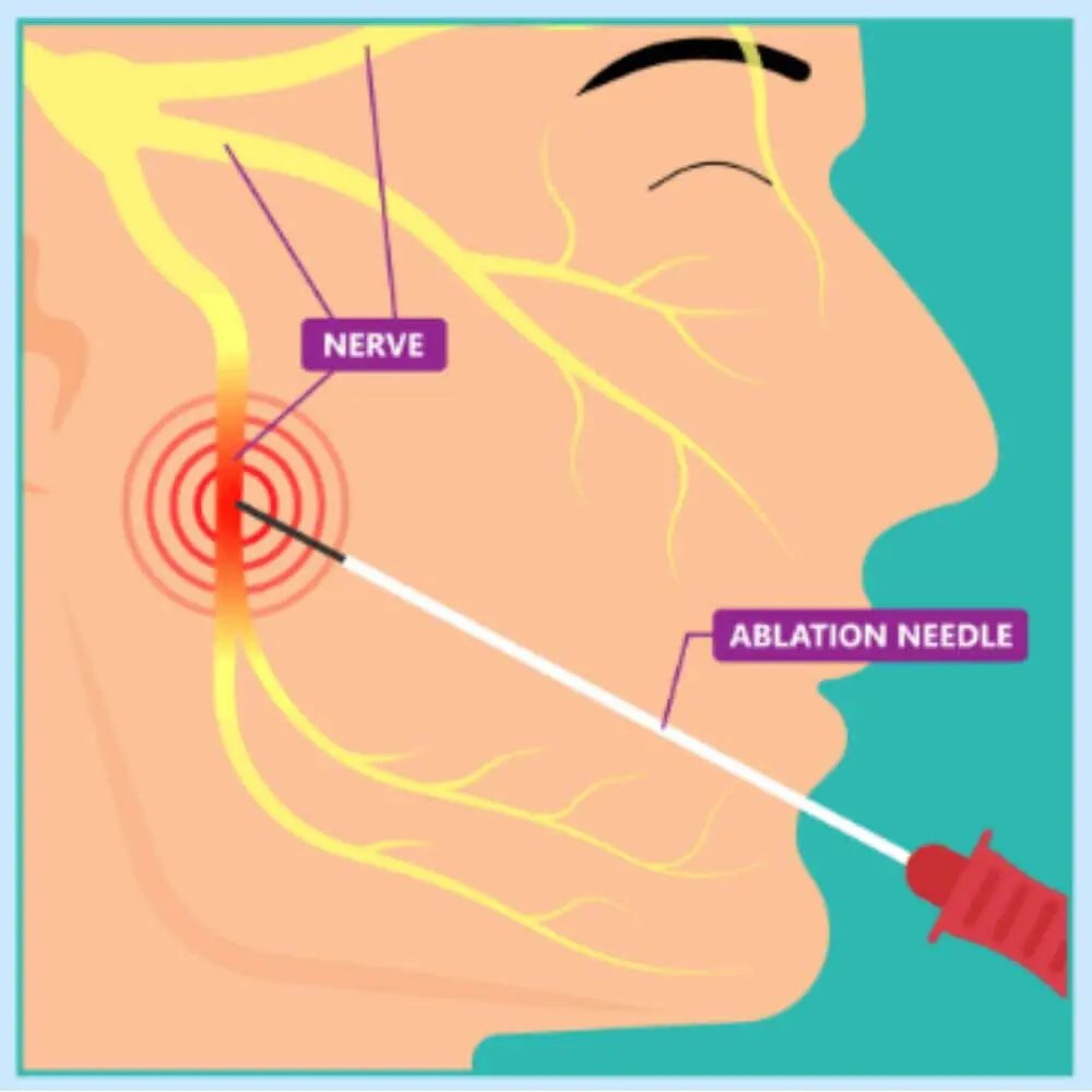Head and neck interventional radiology treatment setup