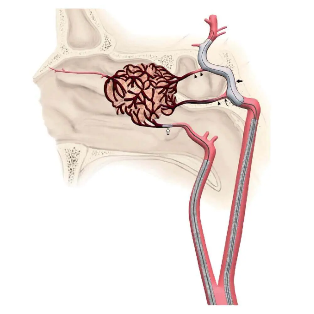 Advanced head and neck interventional radiology scan