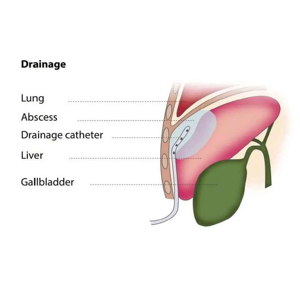 Advanced interventional radiology equipment and procedure