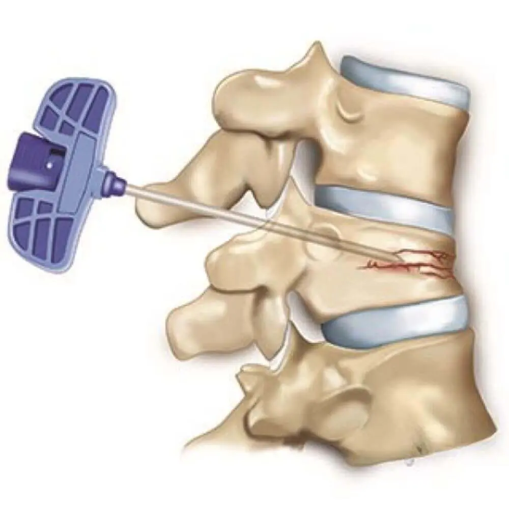 Musculoskeletal interventional radiology procedure