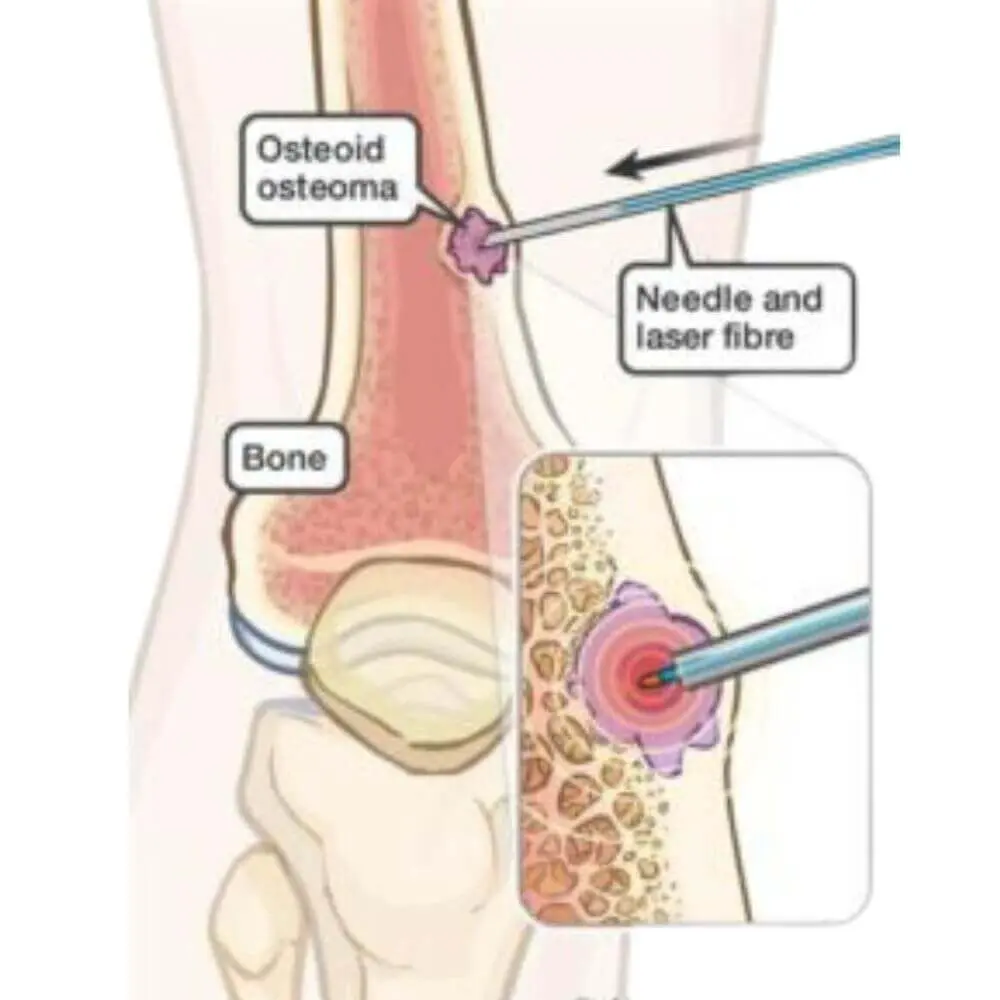 Advanced musculoskeletal interventional radiology treatment