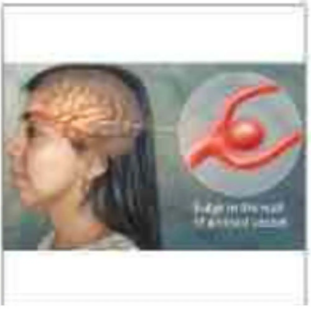 Neuro interventional radiology procedure