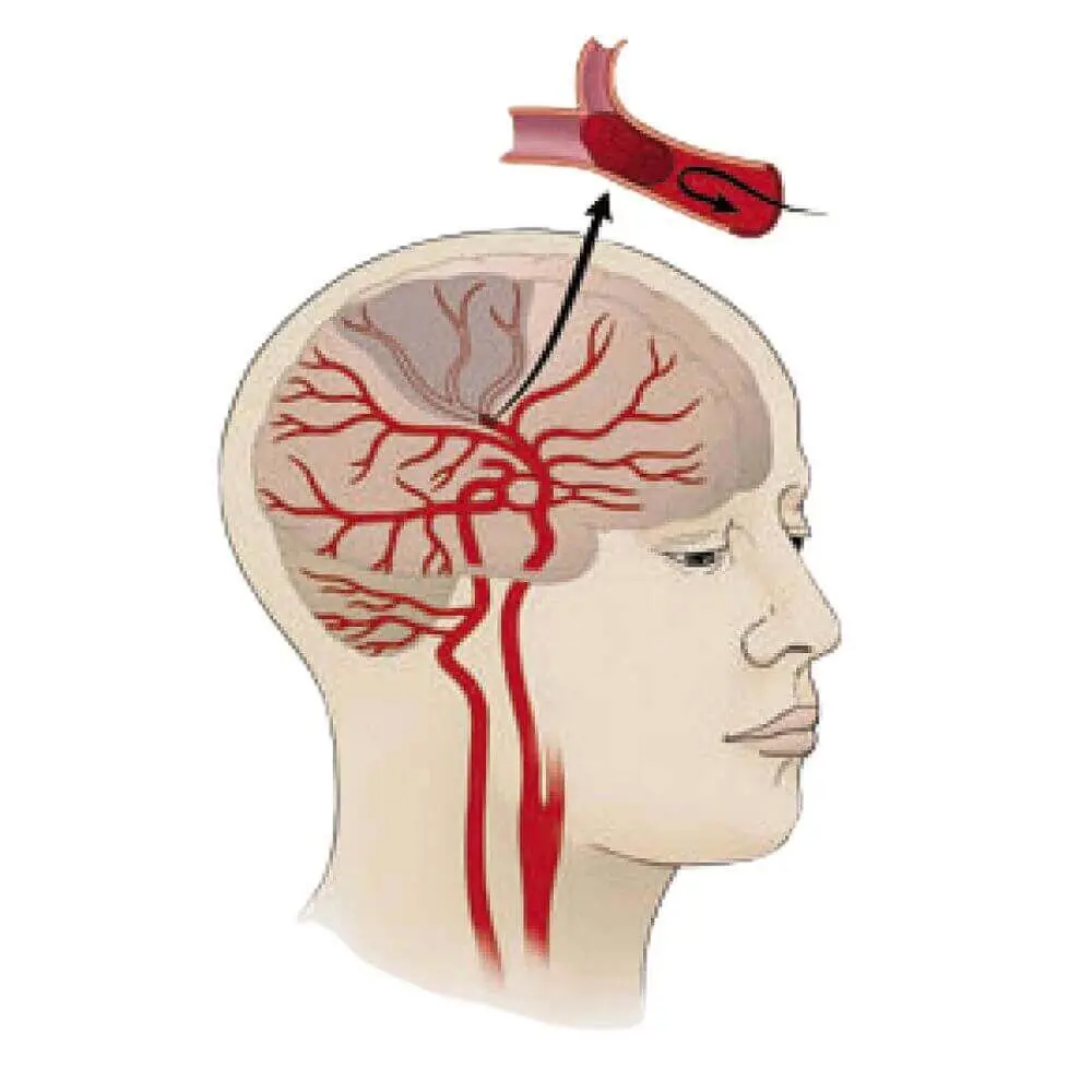 Neuro interventional radiology imaging and analysis