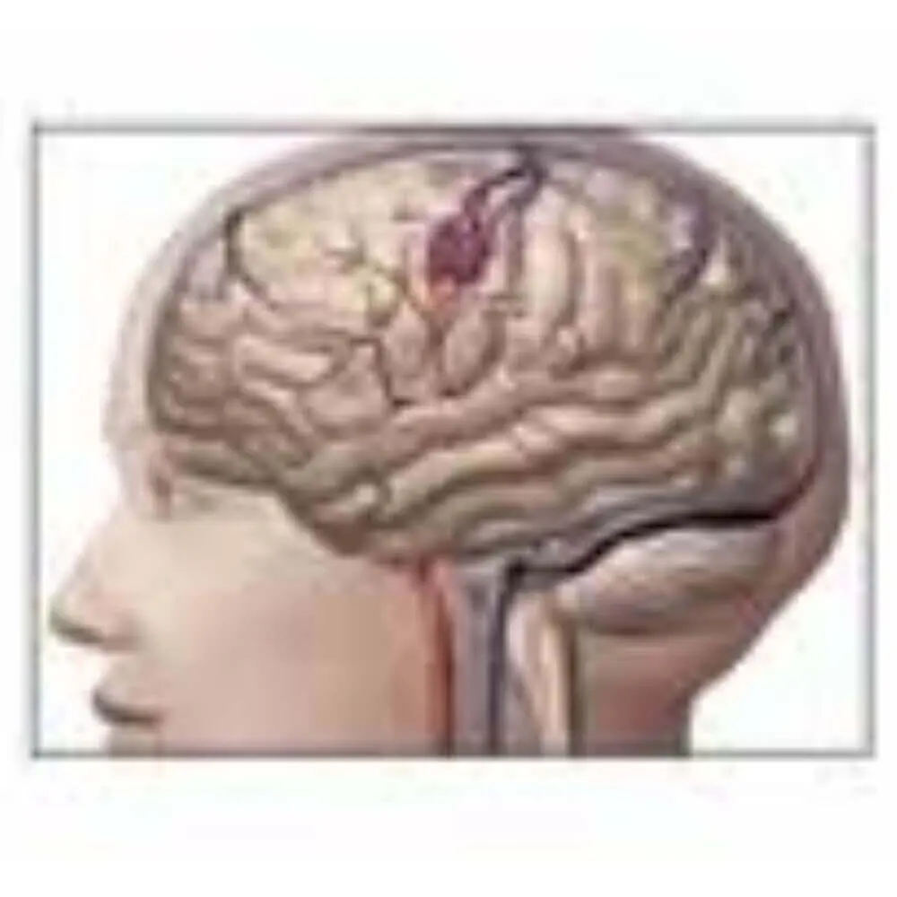 Neuro interventional radiology treatment scan