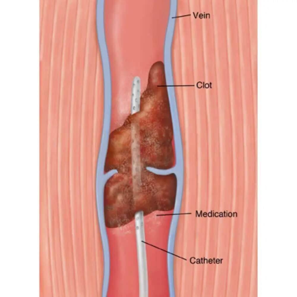 Peripheral vascular interventional radiology procedure