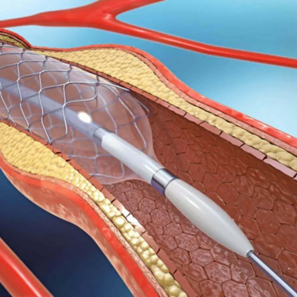 Peripheral vascular interventional treatment scan