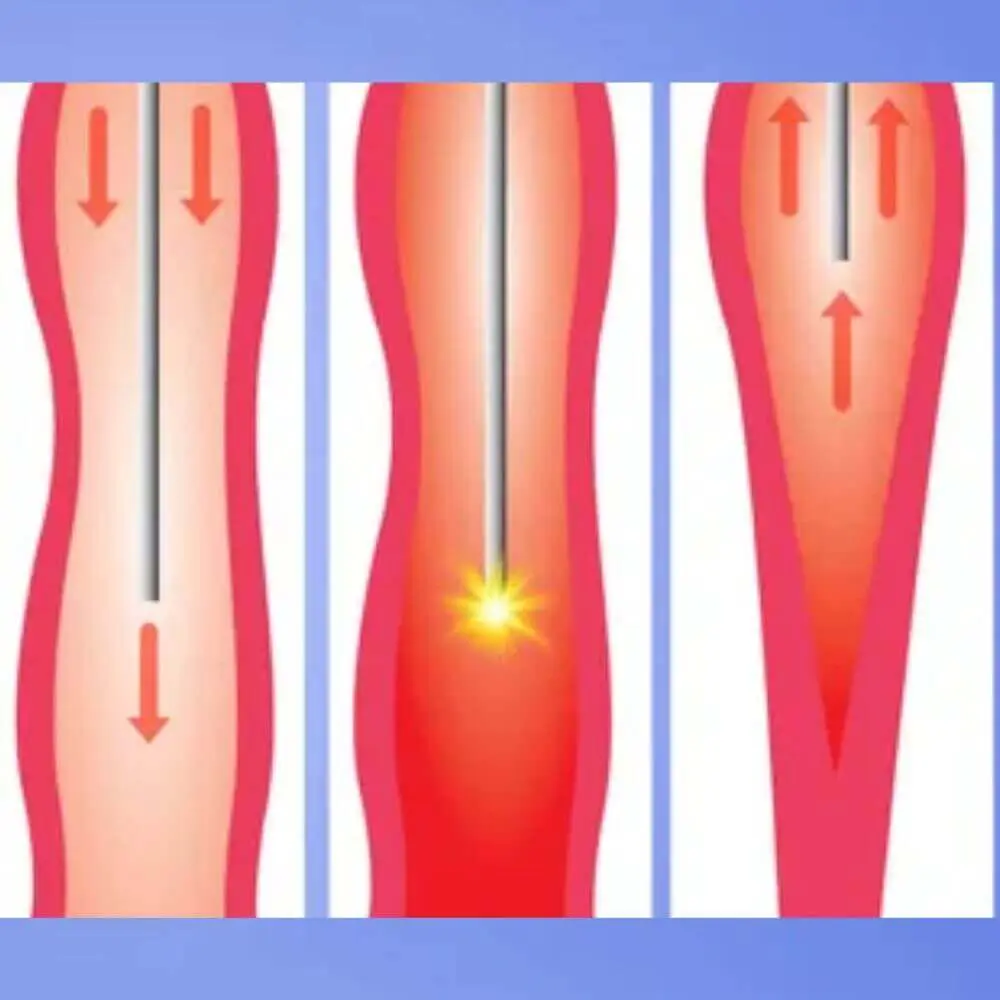 Advanced peripheral interventional radiology procedure