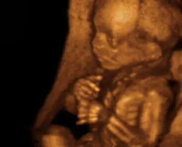 Sonography