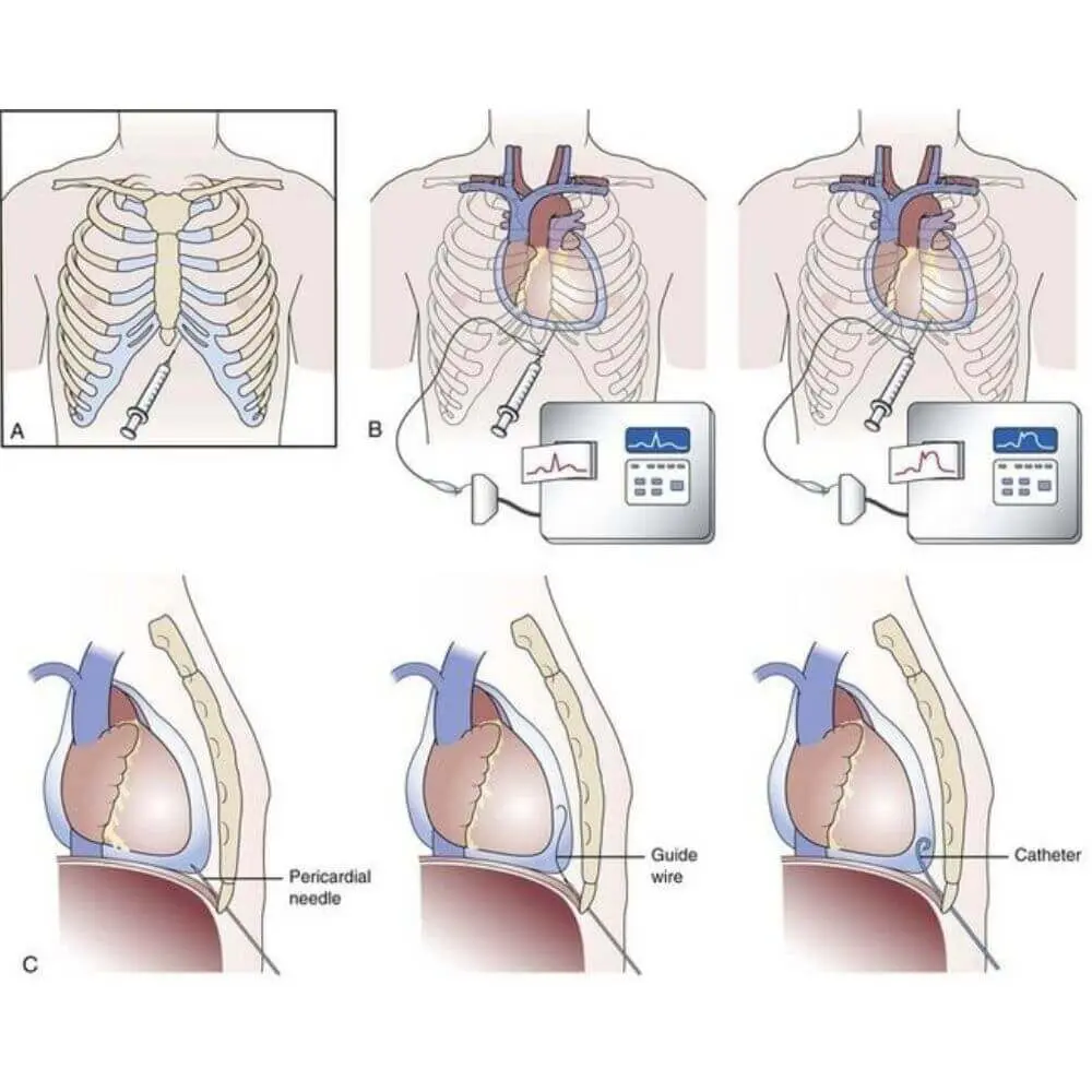 Thoracic interventional radiology procedure