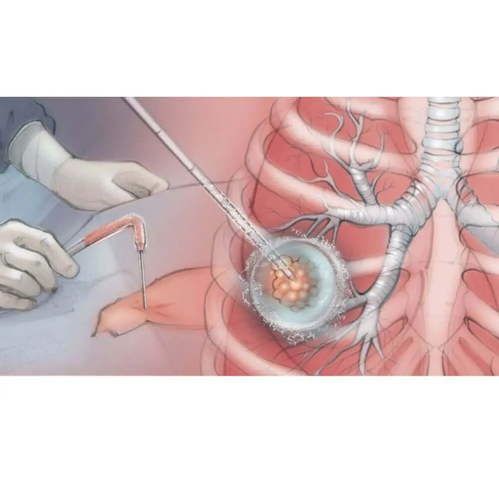 Thoracic interventional treatment image
