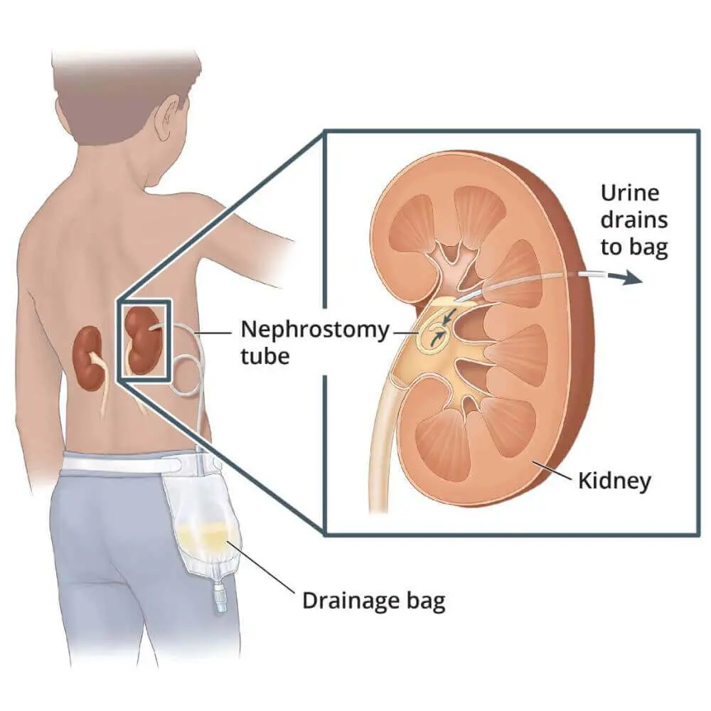 Urological interventional radiology procedure