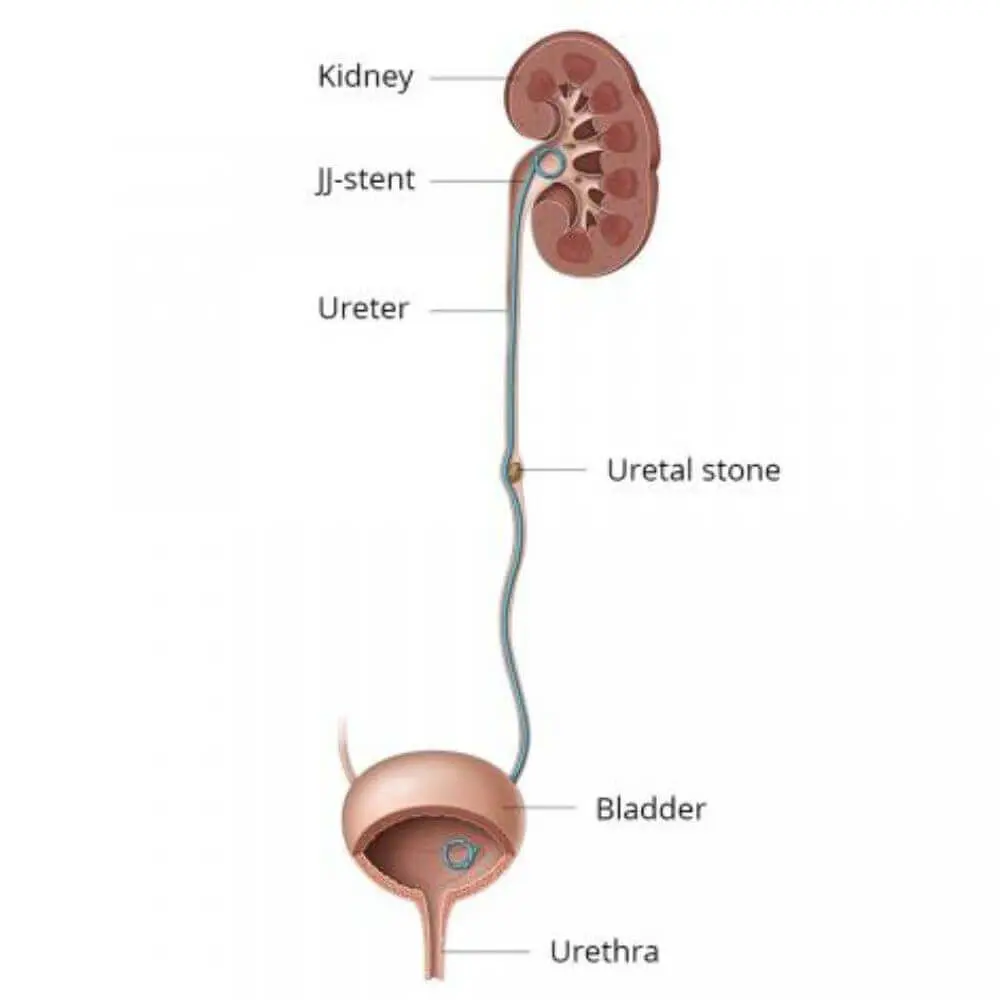 Urological interventional radiology treatment scan