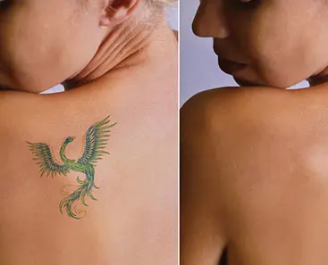 Laser Tattoo Removal