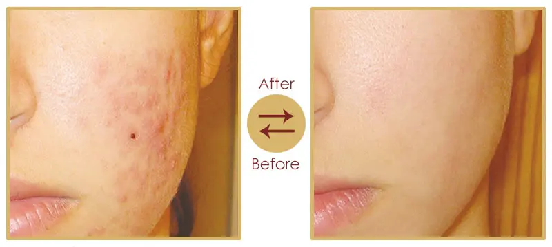 Acne, melasma, and pigmentation skin treatment result 1