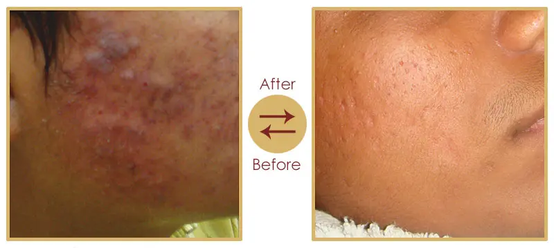 Acne, melasma, and pigmentation skin treatment result 2