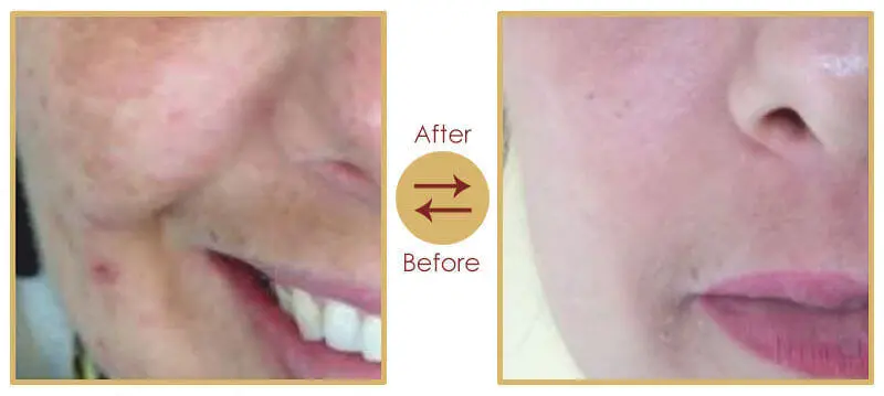 Acne melasma and skin pigmentation laser treatment