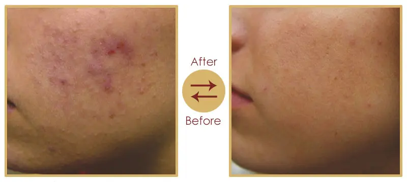 Acne and melasma skin pigmentation treatment before and after result