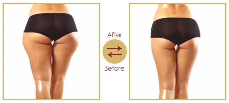 Aesthetic Shape Up Treatment Before and After Result