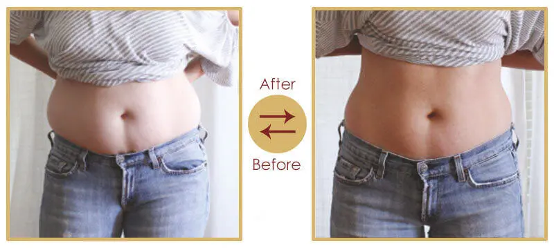Aesthetic Shape Up Treatment Procedure Step 1