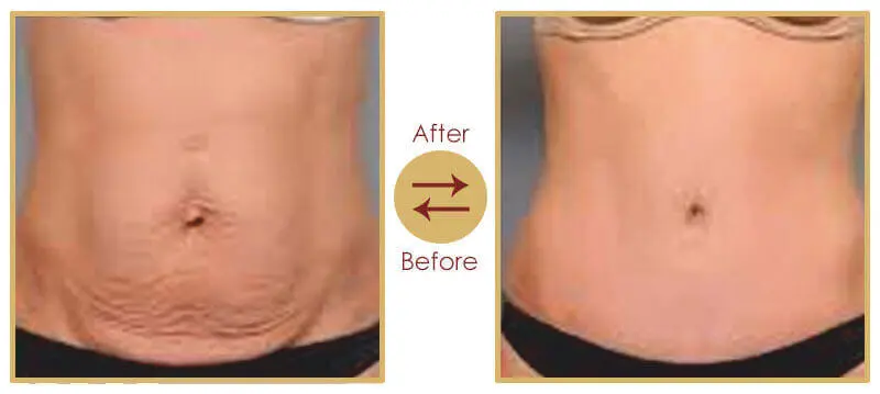 Aesthetic Shape Up Treatment Procedure Step 2