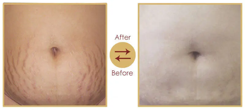 Post pregnancy body contouring and beautification service