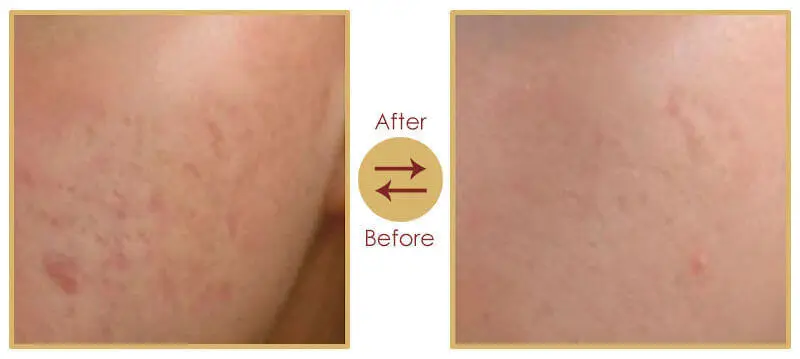 Clear facial skin after laser acne scar reduction therapy
