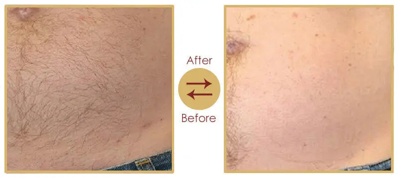 Dermatologist performing laser hair removal on patient