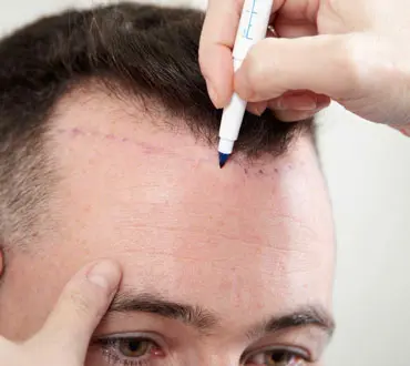 Hair Transplant
