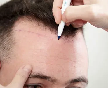 Hair Transplant