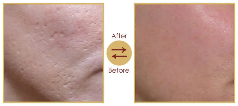 Dermatologist performing laser acne scar treatment procedure