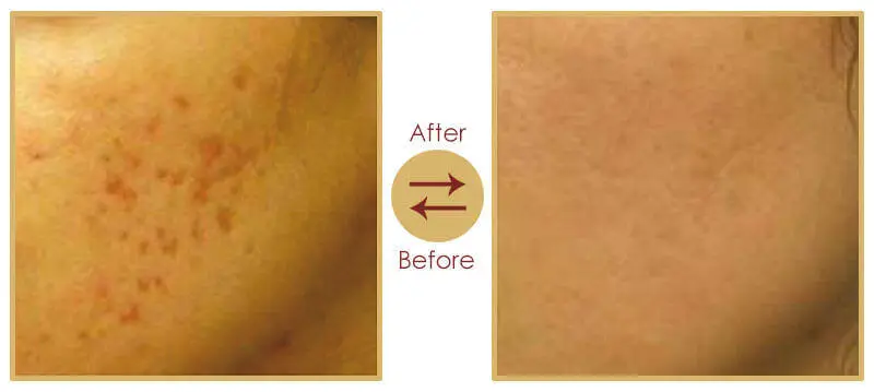 Acne scar laser treatment before and after results