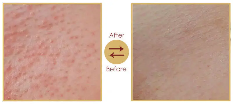 Laser hair removal clinical session at Arihant Centre