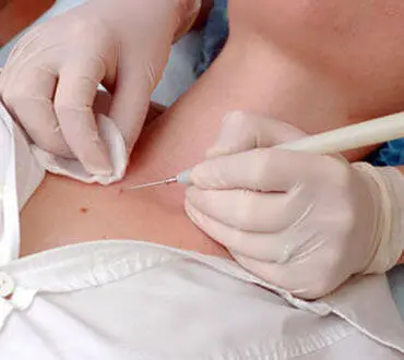 Laser mole and wart removal procedure at Arihant Centre