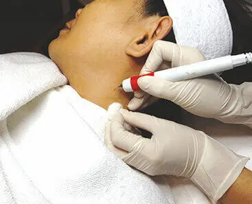 Laser Mole Wart Removal