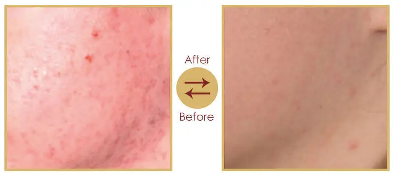 Laser skin resurfacing procedure for acne scar removal