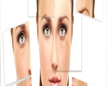 Melasma