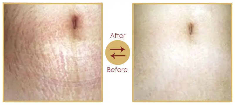 Cosmetic post pregnancy beautification procedure