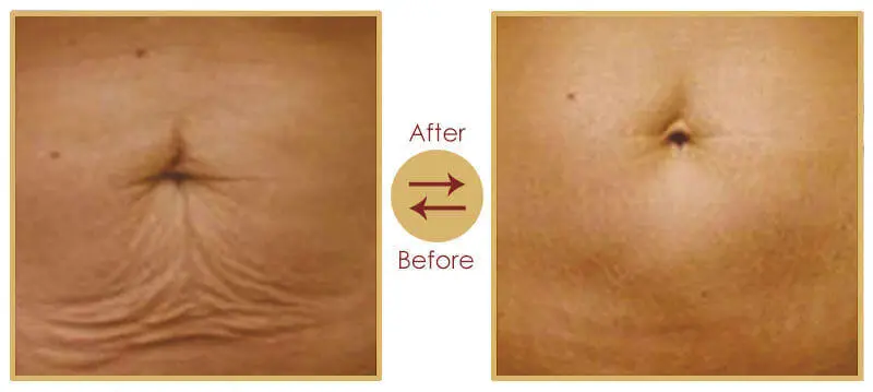 Post natal cosmetic beautification treatment result