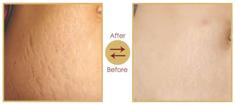 Post pregnancy skin tightening and aesthetic rejuvenation