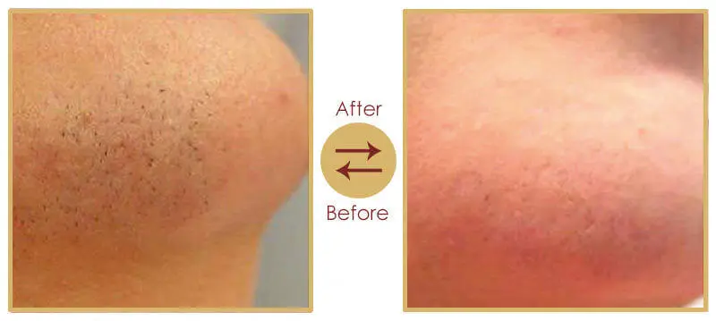 Safe and effective laser hair removal cosmetic service