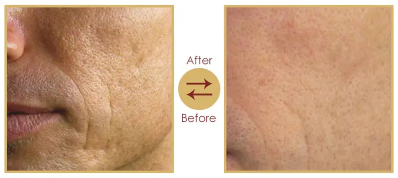 Skin Rejuvenation and Anti-Ageing Skin Tightening Treatment Result 1