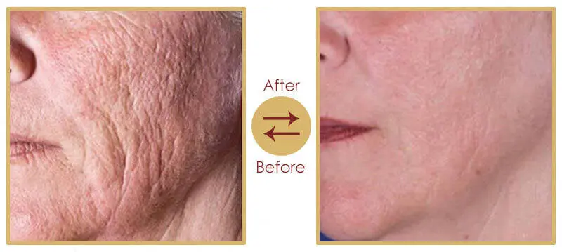 Skin Rejuvenation and Anti-Ageing Skin Tightening Treatment Result 2