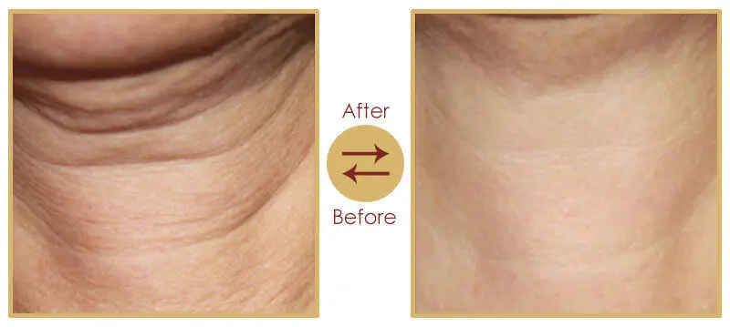 Skin rejuvenation and skin tightening anti-ageing treatment