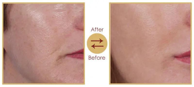 Skin Rejuvenation, Skin Tightening, and Anti-Ageing Treatment
