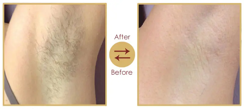 Smooth skin result after laser hair removal treatment
